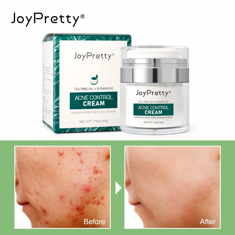 JoyPretty Acne Face Cream Pimple Treatment Tea Tree Anti-inflammatory Acne Scars Clear Pore Moisturiz Facial Creams Skin Care